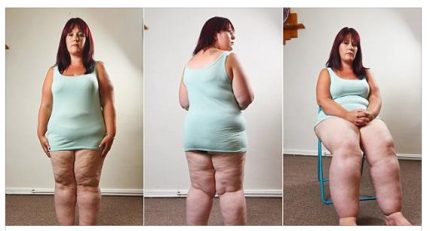 Le sue gambe sono arrivate a pesare 50 kg