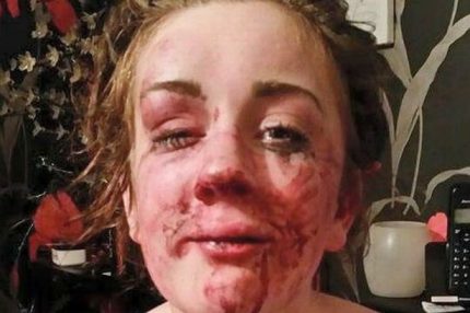 Tia Jade Edwadrs, ragazza madre di soli 17 anni, avrà di certo bisogno di un intervento chirurgico per ridurre la frattura al naso ed un danneggiamento